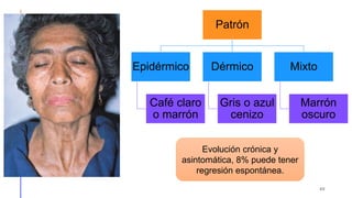 Patrón
Epidérmico
Café claro
o marrón
Dérmico
Gris o azul
cenizo
Mixto
Marrón
oscuro
40
Evolución crónica y
asintomática, 8% puede tener
regresión espontánea.
 