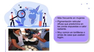 • Más frecuente en mujeres
• Pigmentación reticular
difusa que predomina en
las zonas expuestas a calor
radiante.
• Muy común en tortilleras o
amas de casa que usaban
fogón.
 