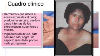 Cuadro clínico
• Dermatosis que afecta a
zonas expuestas al calor;
predomina en cara, cuello y
caras internas de las
extremidades superiores y
muslos.
• Pigmentación difusa, café
oscura o casi negra, de
aspecto reticulado, poco o
nada pruriginosa.
 