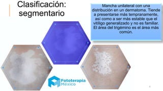 Clasificación:
segmentario
Mancha unilateral con una
distribución en un dermatoma. Tiende
a presentarse más tempranamente,
así como a ser más estable que el
vitíligo generalizado y no es familiar.
El área del trigémino es el área más
común.
7
 