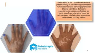 9
GENERALIZADO: Tipo más frecuente de
presentación y se caracteriza por diversas o
numerosas manchas con despigmentación
bilateral y simétrica de la cara
especialmente áreas periorificiales, así
como superficies extensoras como las
articulaciones interfalángicas, metacarpo-
metatarsales, codos y rodillas.
 