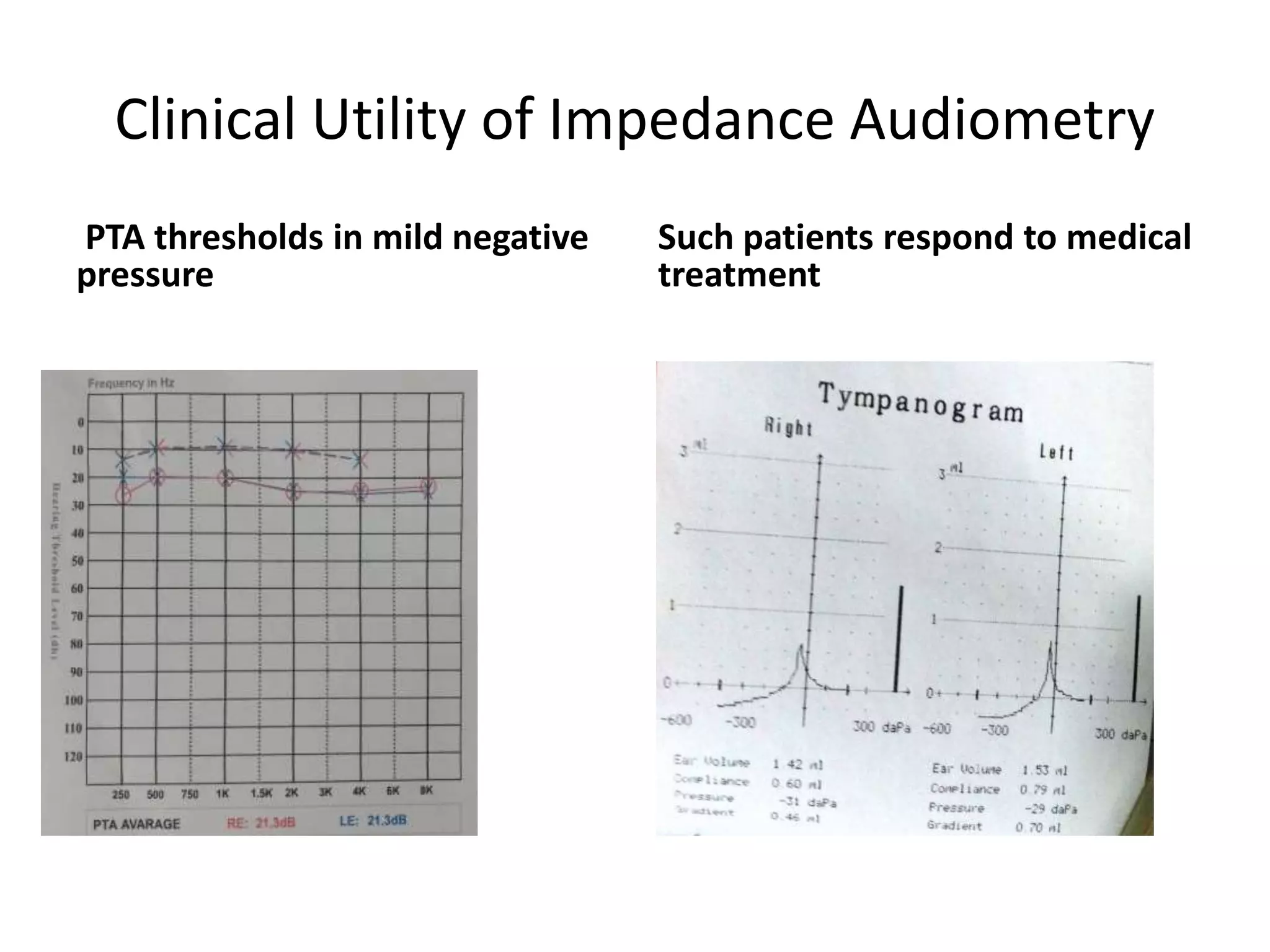 Clinical Utility of Impedance Audiometry
PTA thresholds in mild negative
pressure
Such patients respond to medical
treatment
 