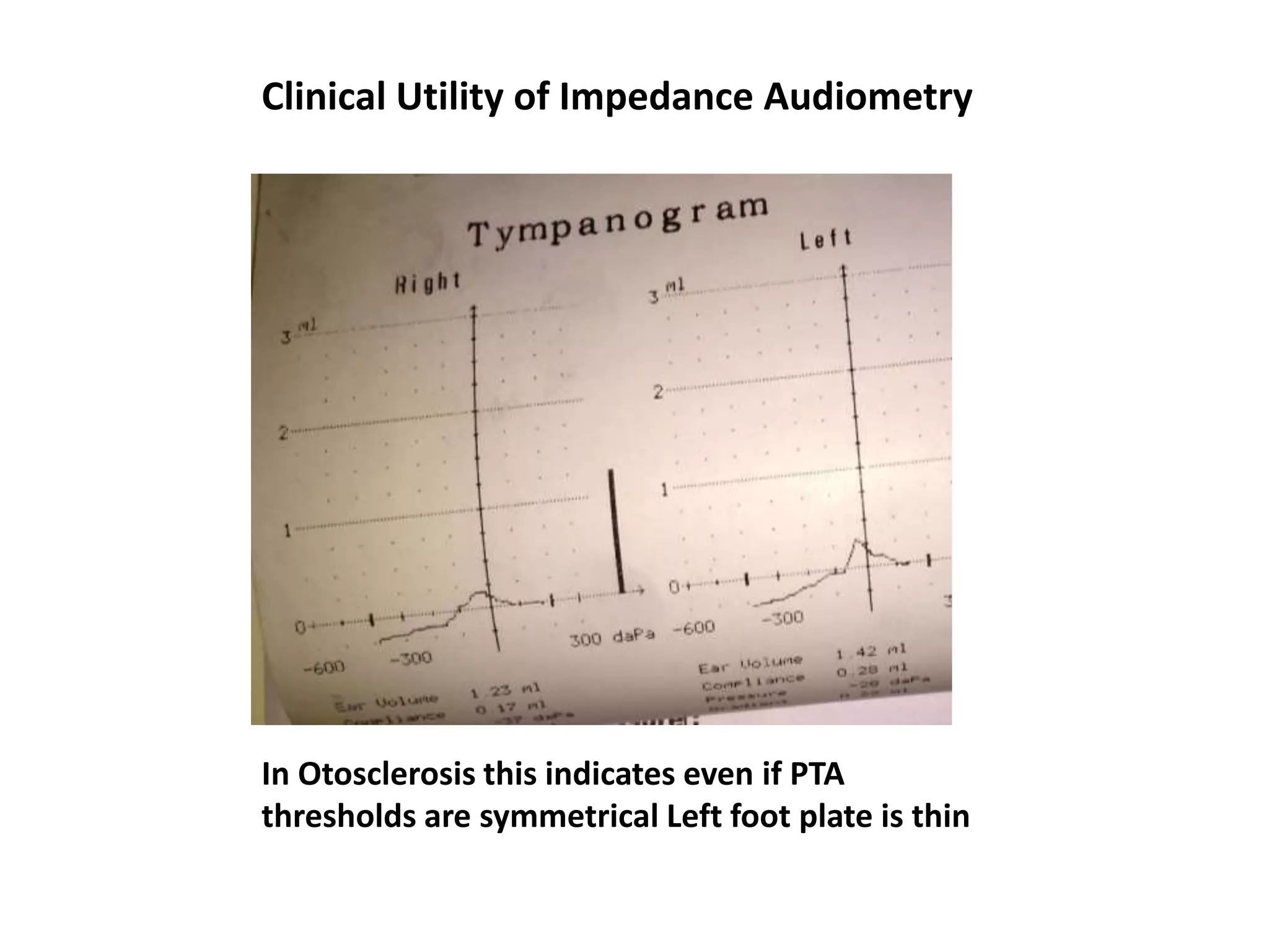 Clinical Utility of Impedance Audiometry
In Otosclerosis this indicates even if PTA
thresholds are symmetrical Left foot plate is thin
 