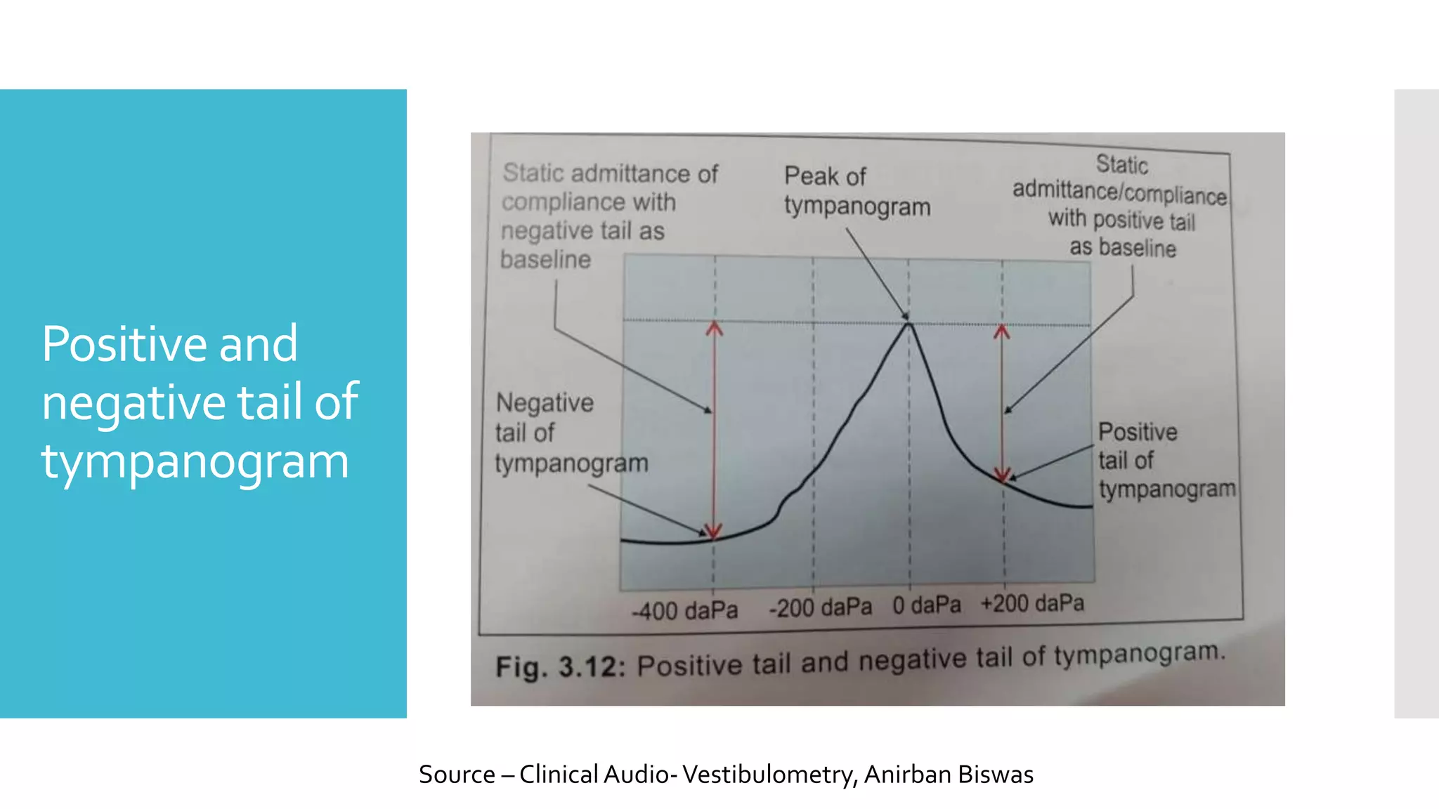 Positive and
negative tail of
tympanogram
Source – ClinicalAudio-Vestibulometry,Anirban Biswas