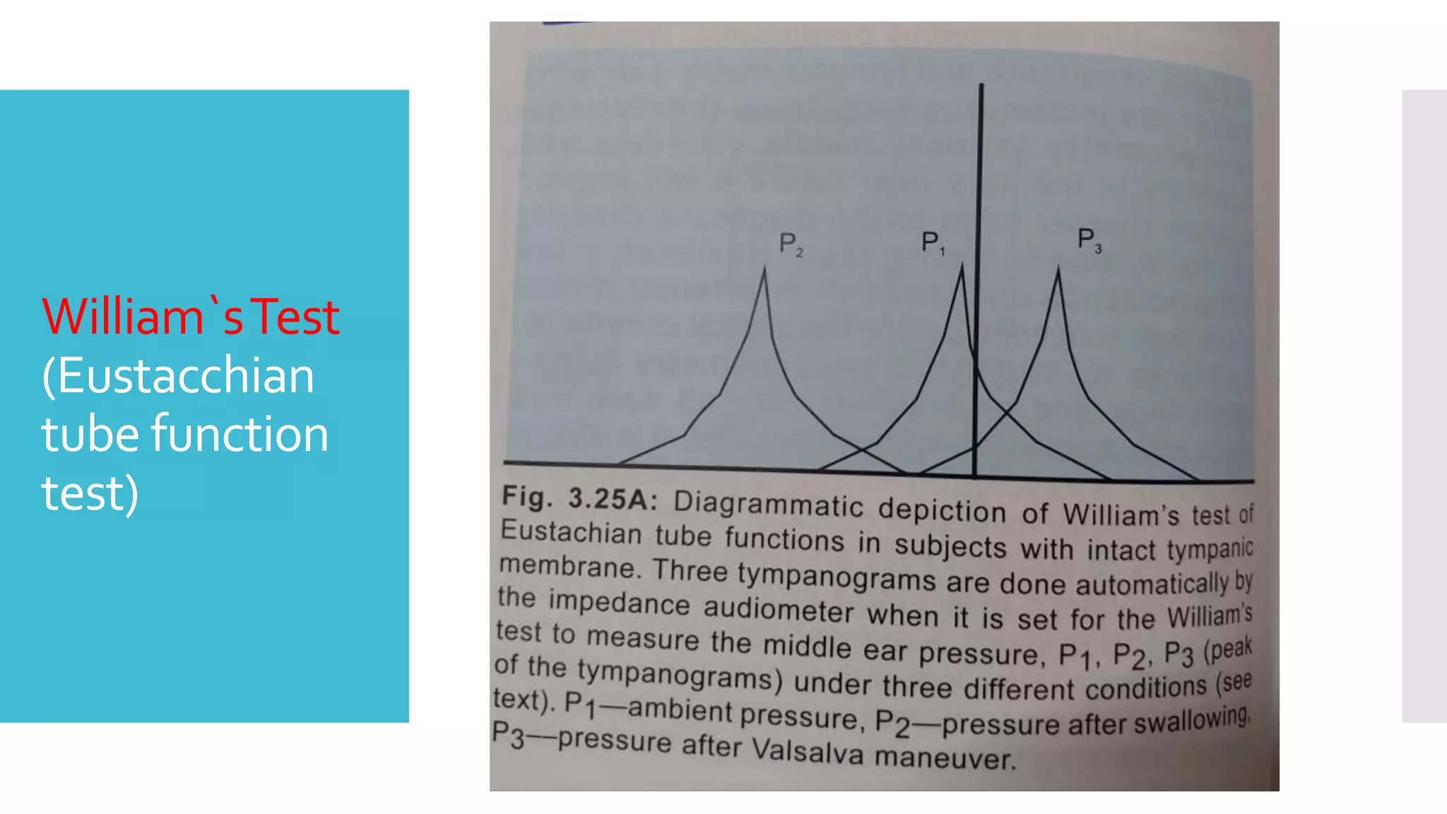 William`sTest
(Eustacchian
tube function
test)