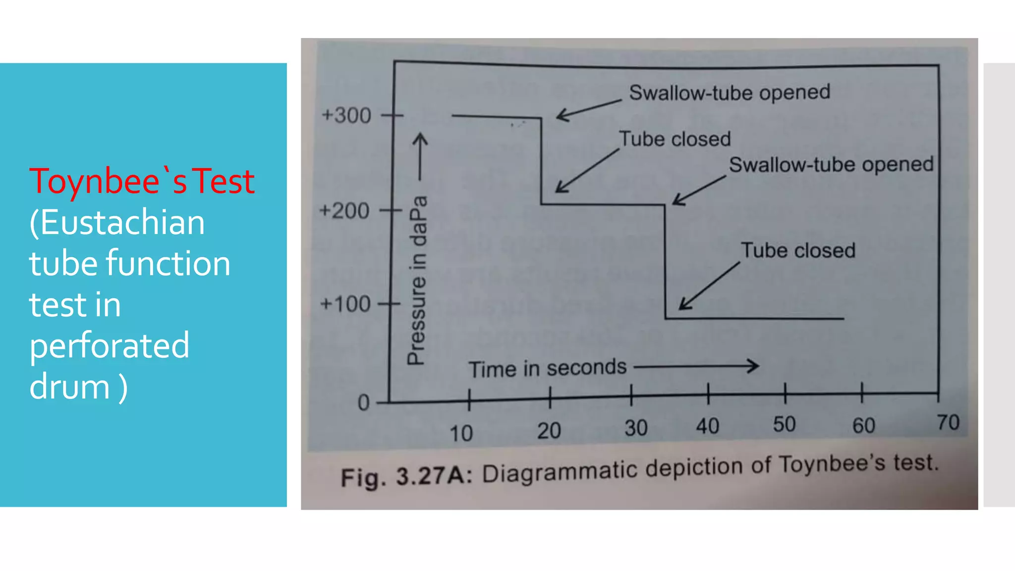 Toynbee`sTest
(Eustachian
tube function
test in
perforated
drum )