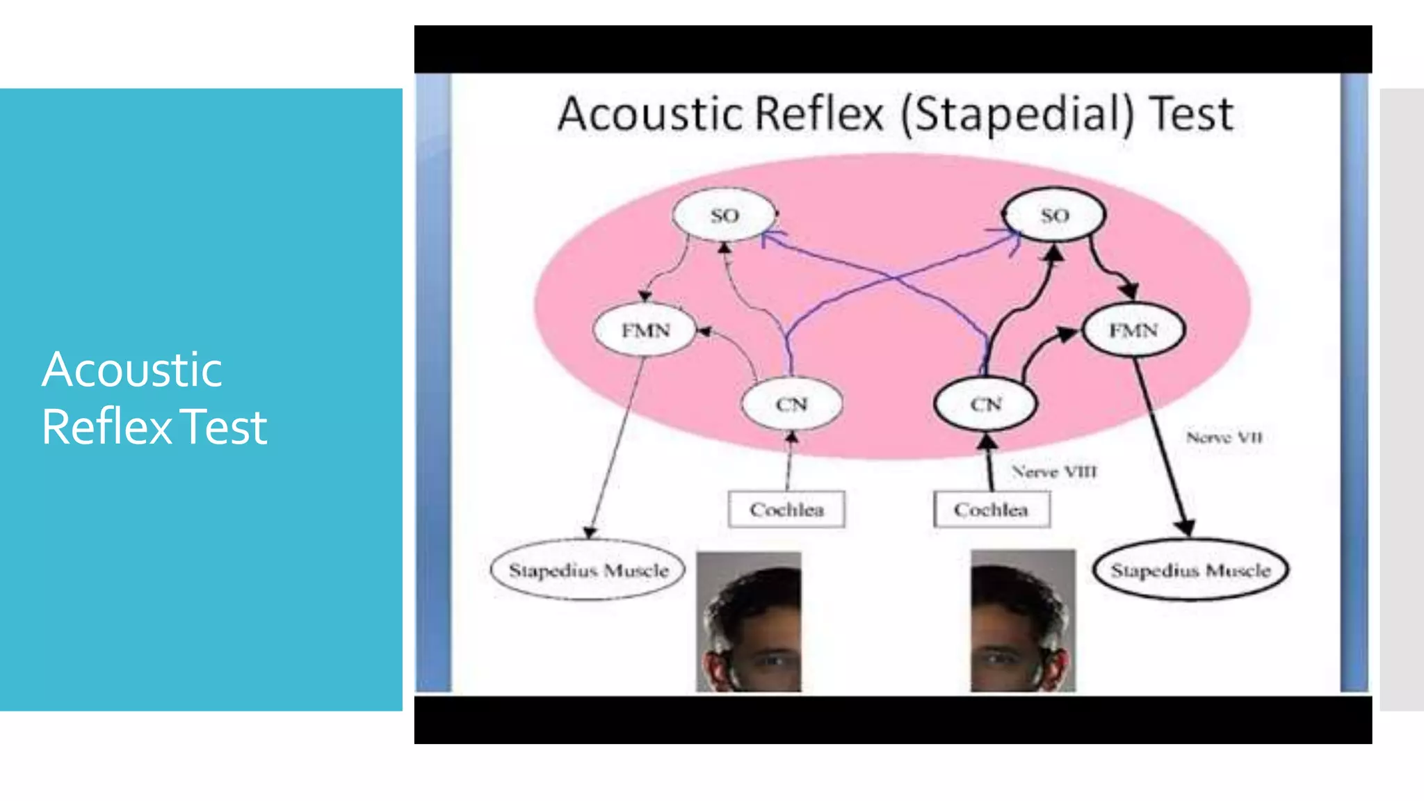 Acoustic
ReflexTest