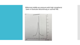 B)Normal middle ear pressure with high compliance
(seen in Ossicular discontinuity or scarred TM)
 