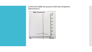 C) Normal middle ear pressure with low compliance
(Otosclerosis )
 