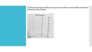 D) Flat tympanogram without any pressure peak or measurable compliance
(Adhesive otitis media)
 