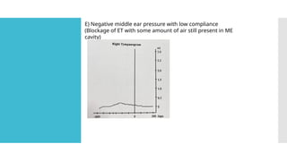 E) Negative middle ear pressure with low compliance
(Blockage of ET with some amount of air still present in ME
cavity)
 