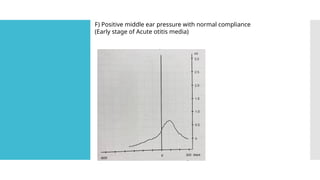 F) Positive middle ear pressure with normal compliance
(Early stage of Acute otitis media)
 