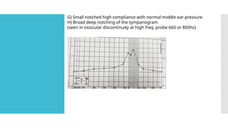 G) Small notched high compliance with normal middle ear pressure
H) Broad deep notching of the tympanogram
(seen in ossicular discontinuity at high freq. probe 660 or 800hz)
 