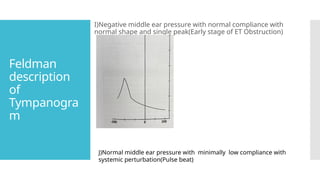 Feldman
description
of
Tympanogra
m
I)Negative middle ear pressure with normal compliance with
normal shape and single peak(Early stage of ET Obstruction)
J)Normal middle ear pressure with minimally low compliance with
systemic perturbation(Pulse beat)
 