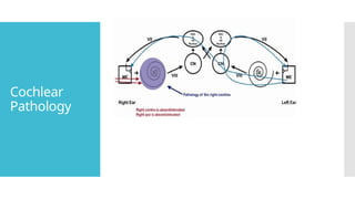 Cochlear
Pathology
 