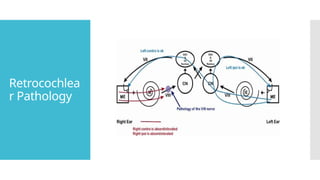 Retrocochlea
r Pathology
 