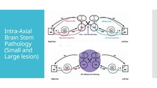 Intra-Axial
Brain Stem
Pathology
(Small and
Large lesion)
 