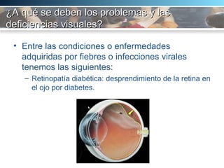 ¿A qué se deben los problemas y las deficiencias visuales? Entre las condiciones o enfermedades adquiridas por fiebres o infecciones virales tenemos las siguientes:  Retinopatía diabética: desprendimiento de la retina en el ojo por diabetes.  