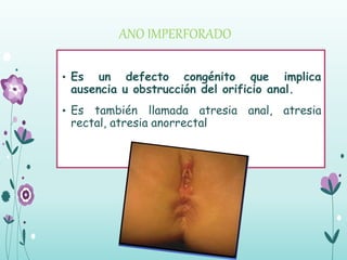 ANO IMPERFORADO
• Es un defecto congénito que implica
ausencia u obstrucción del orificio anal.
• Es también llamada atresia anal, atresia
rectal, atresia anorrectal
 