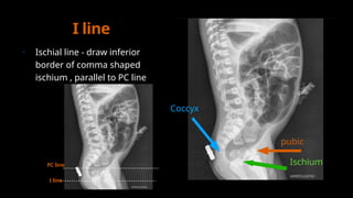 Imperforate anus radiology diagnosis.pptx