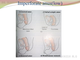 Imperforate anus(low)
1.Covered anus 2.Vulval ectopic anus
3.Stenosed anus 4.Membranous stenosis
 