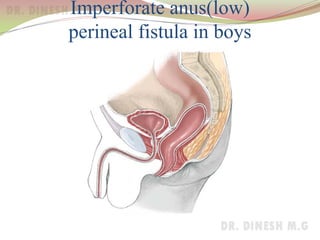Imperforate anus(low)
perineal fistula in boys
 
