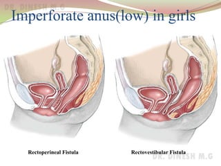 Imperforate anus(low) in girls
Rectoperineal Fistula Rectovestibular Fistula
 