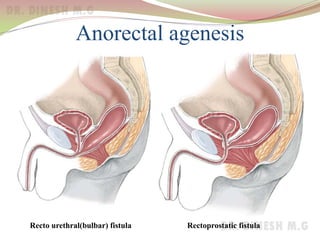 Anorectal agenesis
Recto urethral(bulbar) fistula Rectoprostatic fistula
 