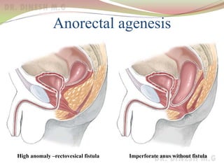 Anorectal agenesis
Imperforate anus without fistulaHigh anomaly –rectovesical fistula
 