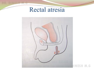 Rectal atresia
 