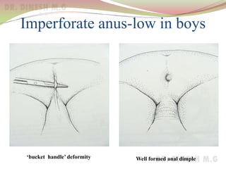 Imperforate anus-low in boys
‘bucket handle’ deformity Well formed anal dimple
 