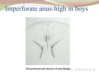 Imperforate anus-high in boys
Flat perineum and absence of anal dimple
 