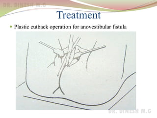 Treatment
 Plastic cutback operation for anovestibular fistula
 