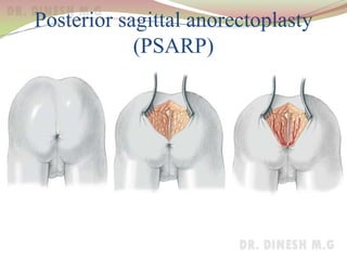 Posterior sagittal anorectoplasty
(PSARP)
 
