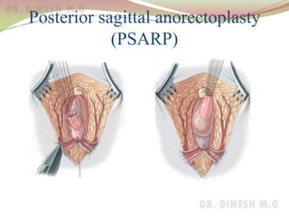 Posterior sagittal anorectoplasty
(PSARP)
 