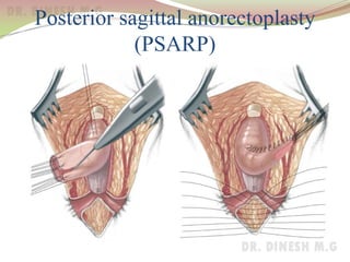 Posterior sagittal anorectoplasty
(PSARP)
 