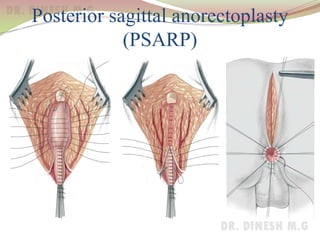 Posterior sagittal anorectoplasty
(PSARP)
 