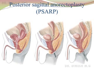 Posterior sagittal anorectoplasty
(PSARP)
 