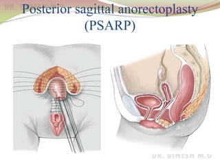 Posterior sagittal anorectoplasty
(PSARP)
 