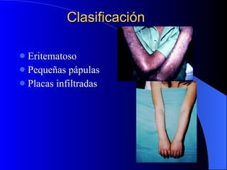 Clasificación Eritematoso Pequeñas pápulas Placas infiltradas 