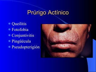 Prúrigo Actínico Queilitis Fotofobia Conjuntivitis Pingüécula Pseudopterigión 