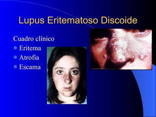Lupus Eritematoso Discoide Cuadro clínico Eritema Atrofia Escama 