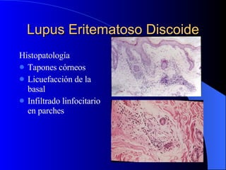 Lupus Eritematoso Discoide Histopatología Tapones córneos Licuefacción de la basal Infiltrado linfocitario en parches 