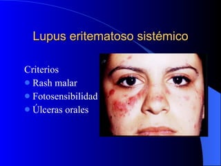 Criterios  Rash malar Fotosensibilidad Úlceras orales Lupus eritematoso sistémico 