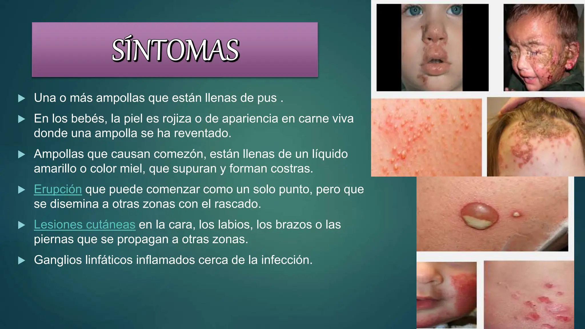 Impetigo Guia De Practiuca Clinica Recomendaciones pptx Skin And 
