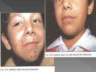 Impetigo - dermatologia