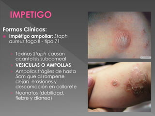 Formas Clínicas: 
 Impétigo ampollar: Staph 
aureus fago II - tipo 71 
› Toxinas Staph causan 
acantolisis subcorneal 
› VESICULAS O AMPOLLAS 
› Ampollas frágiles de hasta 
5cm que al romperse 
dejan erosiones y 
descamación en collarete 
› Neonatos (debilidad, 
fiebre y diarrea) 
 