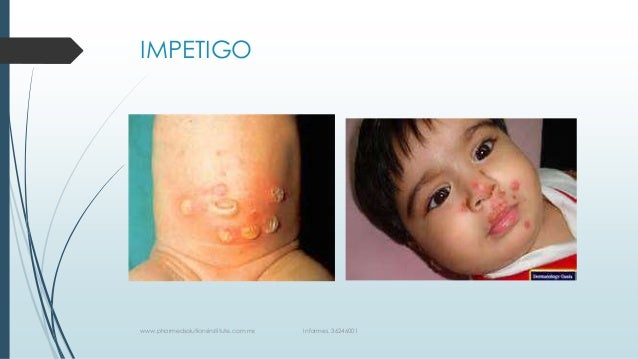 Impetigo Vulgar