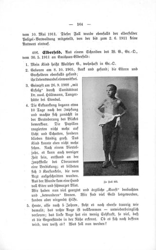 164
bom 10. lltoi 1911. giefer SoII tourbe'ebenfallgbet elbe{elbet
polfuei=Serboltungmitgeteilt,bon ber bia.6um2.6. L911feine
?Inttporteinttof.
406. Glbetfetö. uIuBetnemgdlreibenbeBS. 6., 6t.=D.,
bom30.5.191.1ott Gm6loat=Glberfelb:
.
L. SJtein.RinbbeibtSoltler @.,toolnloftin @r'=D'
Z. @eborenom 8. 1.0.1905, liorf unb gefunb;bie @lternunb
Gtofielternebenfollagefunb;
ibt SebenBlPonbeIeinruonbfrei.
3. @eimPftom26.9.1908,pit
G{oIg" bur$ 5qnitätgtst
Dr.med..büI6monn,Eonger=
ütte bei 6tenbol.
4. Sie @rfronfungbegonnetbn
10 SogenoÖ berSnlPfung
unb ruo$tetiü 3unö$ftin
berEerönberungbecSlidea
bemetfbor. $ie $uPillen
reogtettennt$t melr ouf
Siüt unb 6$otten, fonbern
bliebenltönbig grofi. SoB
,.ßinbfonnteebenniüt meYlr
ie!en. ItoÜ einemSiertel=
iobr, eBfonn oud)toeniger
Seit fein, entfianbon ber
Smpflte[e be1 DberotmeB
eineEerbiüung;eBbilbeten
iiü 3 ,Roriunfeln,bie bom
Wr6toufgef$nittentuurben.
?IuBbet[Sunbefsm eine$onb
uollGiterunbf$mor6e1E[ut.
unb ,,bebunbern"fönnen.
fonberiobernitgenber,$ilfe-
5. $eu!e,olfo nocf)5 $olren, fte[1teB nod) ebenfotroudg toie
bomolg;boa re$te2lugeift bollfontmen untuieberbringltdt
berlor:en;bo6Iinfe ?Iugelot ein tuenige,eh1fr,alt,fo biel, bo$
eBbie@egenftönbein betftöle etfennt.Db egfü noü1beffetn
toitb,tuettuetfieB? lSoBfoll nun toerben?
3u 8q[ 405'
unb ör6t[i$e,,,Runft'beobosten
Sir finb uiel 6elb IoBgetoorben,
 