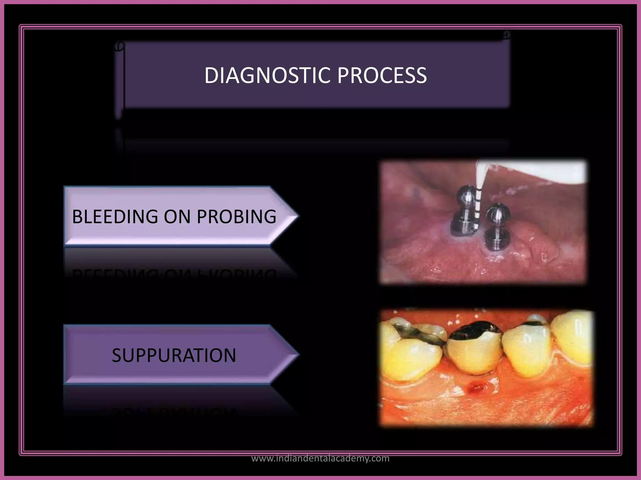 DIAGNOSTIC PROCESS
BLEEDING ON PROBING
SUPPURATION
www.indiandentalacademy.com
 